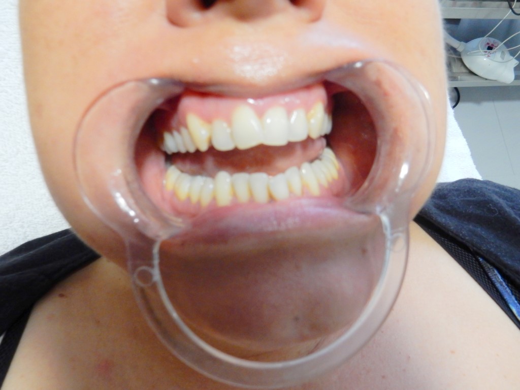 Kwalificatie uitvoeren conservatief Review: tanden bleken | beautytag